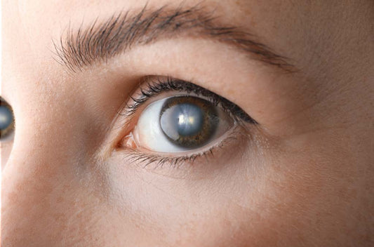 Cataracts and Your Vision: Causes, Symptoms, and How to Manage Them
